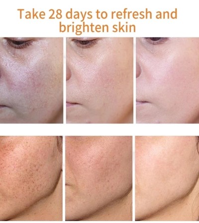 Whitening Freckle Cream Remove Melasma Cream Remove Dark Spots Melanin Melasma Remover Brighten Skin Anti-Aging Skin Lightening